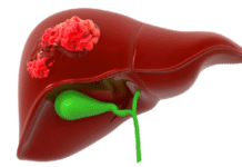 বিশ্বজুড়ে দ্বিগুণ হতে পারে লিভার ক্যান্সার, প্রতিরোধযোগ্য অধিকাংশ : গবেষণা লিভার ক্যান্সার