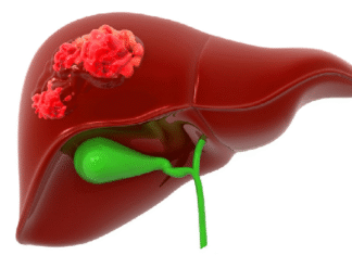 বিশ্বজুড়ে দ্বিগুণ হতে পারে লিভার ক্যান্সার, প্রতিরোধযোগ্য অধিকাংশ : গবেষণা লিভার ক্যান্সার